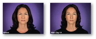 woman frowning before and after botox injections