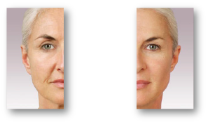 woman's face before and after botox treatment