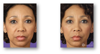 woman's face expressionless before and after botox treatment