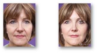 woman smiling before and after cosmetic injections