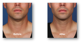 man's under chin area before and after kybella treatment