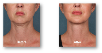 woman's under chin before and after kybella treatment