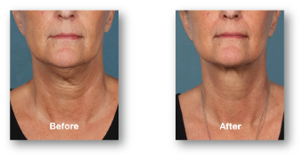 older woman's under chin before and after kybella treatment