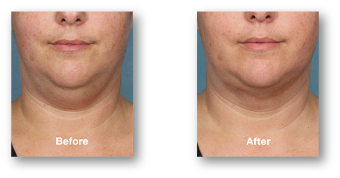 woman's chin fat before and after kybella treatment