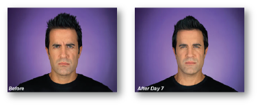 man frowning before and after botox treatment