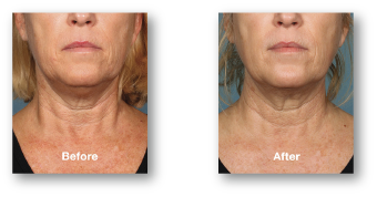 woman's under chin area before and after kybella treatment