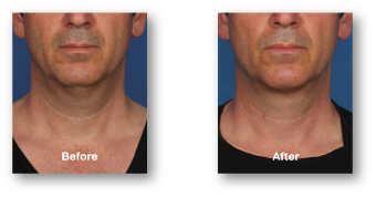 man's chin before and after kybella treatment