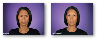woman frowning before and after receiving botox treatment
