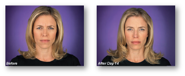 woman frowning before and after botox treatment