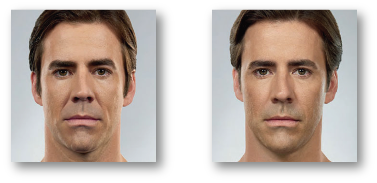 man's face before and after Botox treatment