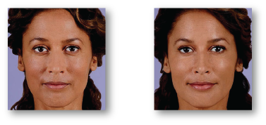 woman before and after receiving botox treatment
