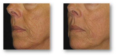 woman's cheek before and after skin rejuvenation treatment for skin tightening