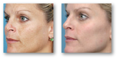 blonde woman's face before and after skin rejuvenation treatment