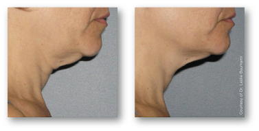 older person's neck from side view before and after skin tightening treatment