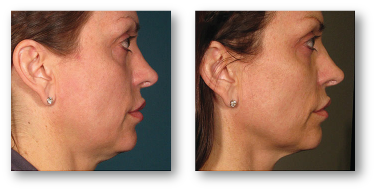 side view of woman's face before and after skin rejuvenation treatment