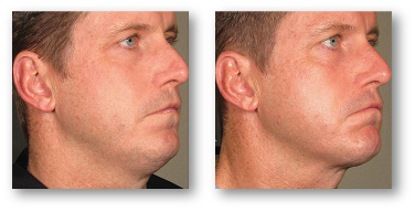 man's face before and after skin tightening treatment