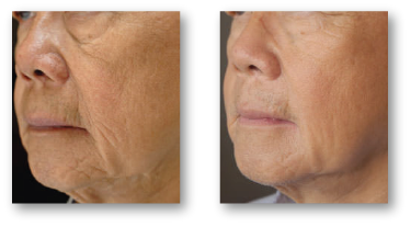 older person's neck before and after skin rejuvenation treatment