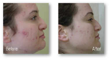 woman's cheek before and after skin rejuvenation treatment for acne