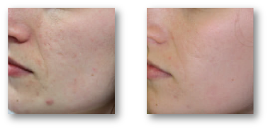 woman's cheek before and after acne scarring treatment